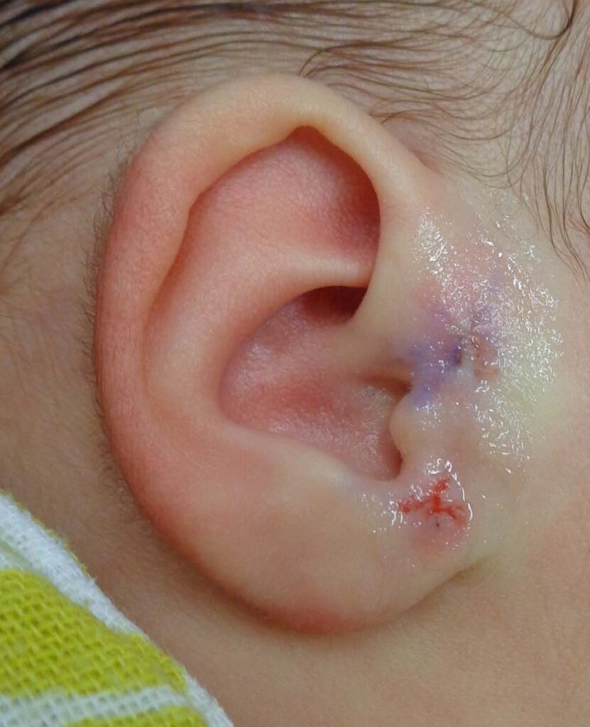 A right ear with two surgical sites. The uppermost area has a sheen from surgical glue and a purple discolouration from texta. The lower site has a small amount of red blood visible around the pale coloured dissolving stitch.
