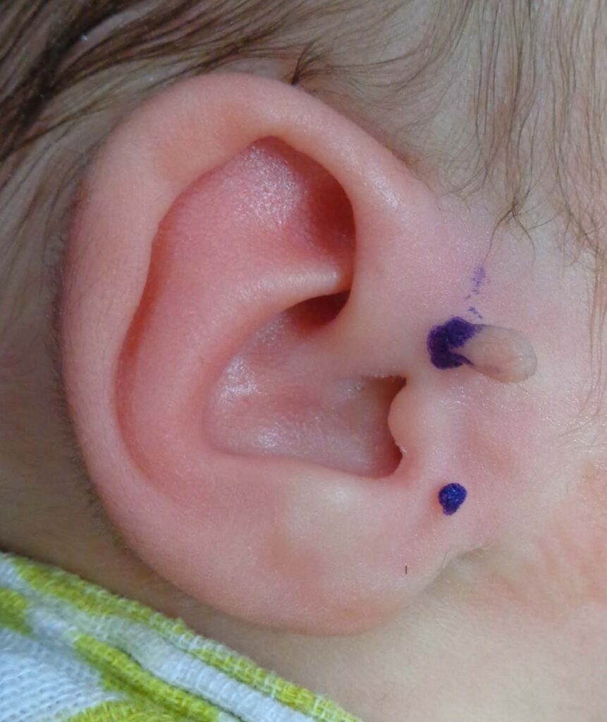 Right ear with two accessory tragi; the skin tags are marked with purple texta at the base of the tissue