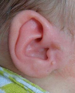 Image of a right ear with two accessory tragi before removal – after local anaesthetic cream has been removed.